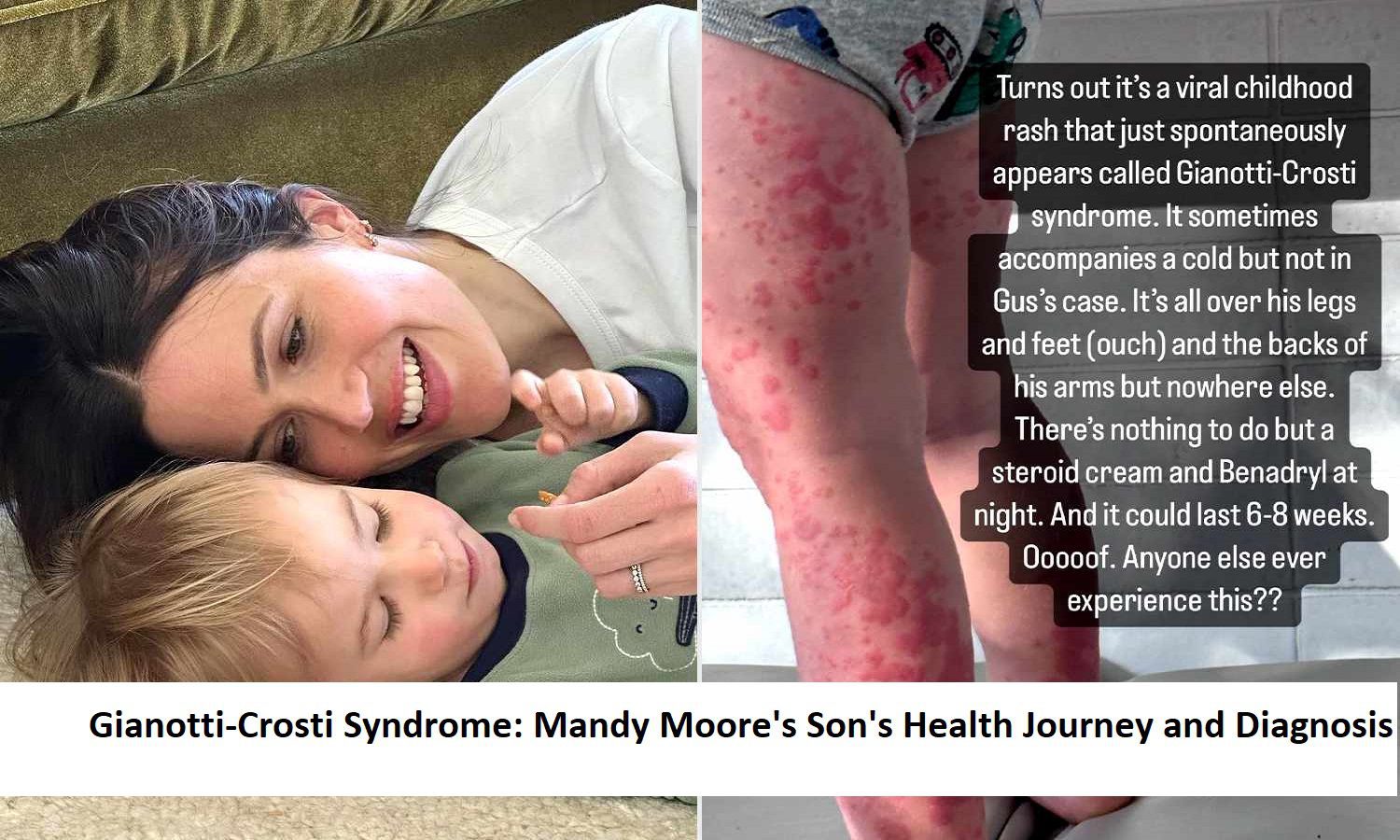 Gianotti-Crosti Syndrome: Mandy Moore's Son's Health Journey and Diagnosis