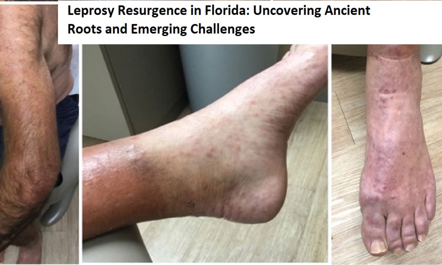 Leprosy Resurgence in Florida Uncovering Ancient Roots and Emerging Challenges